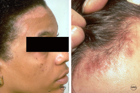 Seborrheic dermatitis along Black woman’s hairline and on white man’s scalp
