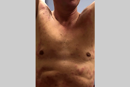 man with cold panniculitis