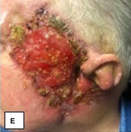 Card image for DWII on IL-36 and pyoderma gangrenosum