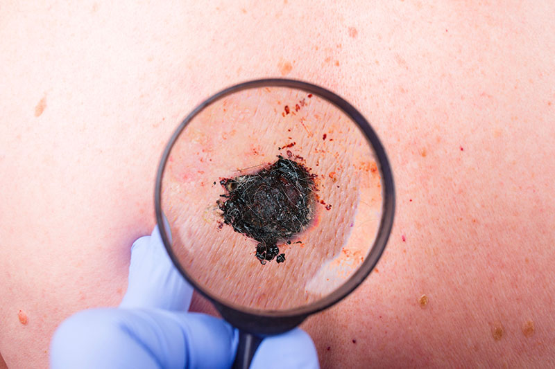 Melanoma Magnification