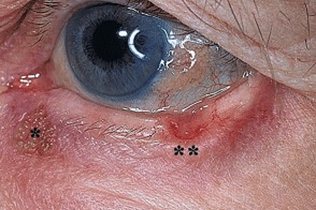 Two basal cell carcinomas on lower eyelid
