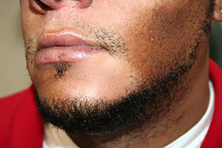 Hair loss on a man’s chin due to cutaneous T-cell lymphoma