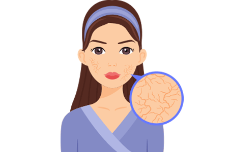 Illustration of woman with spider veins on her cheeks