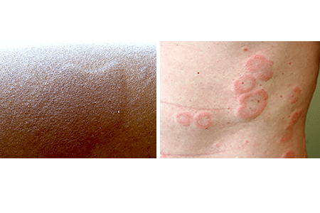 hives on black people skin