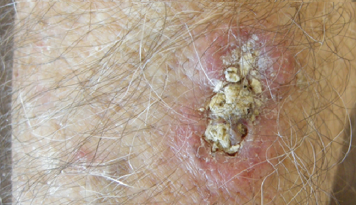 Close up of a cutaneous squamous cell carcinoma.
