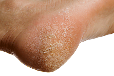 Close-up of a dry, cracked heel on a woman's foot