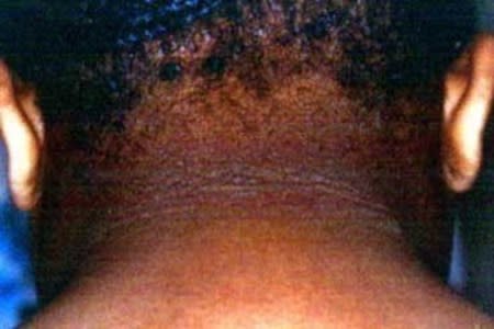 Acanthosis nigricans in the folds of the neck