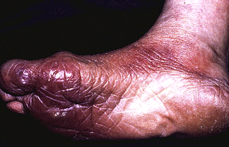 Swelling, hardened skin, and deep lines on the foot of someone who has had Lyme disease for years.
