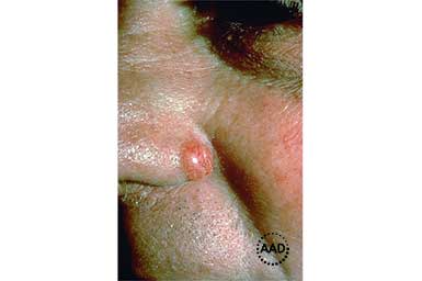 Pinkish, red nodular basal cell carcinoma on nose | American Academy of Dermatology