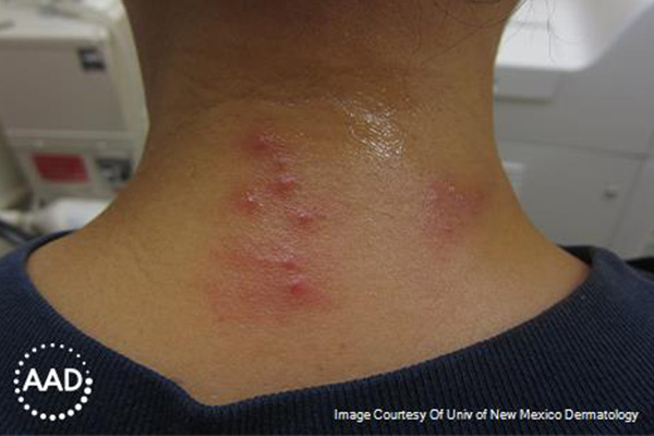 Varicella-zoster figure 3. Clustered erythematous papulovesicles on the posterior neck with surrounding mild erythema. Source: AAD.
