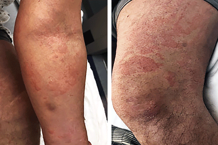 Arm with measles-like rash (left) and leg with measles-like rash (right) due to COVID infection.