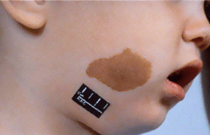 Birthmarks Signs And Symptoms