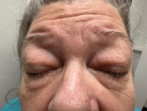 Image for DWII of periocular hypopigmentation of the elderly