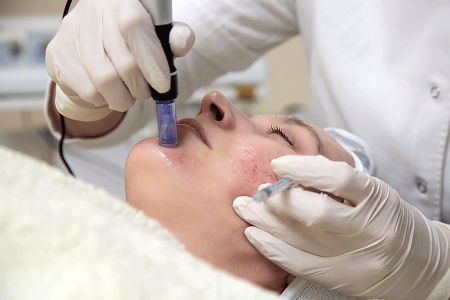 Woman having microneedle cosmetic treatment performed by a dermatologist