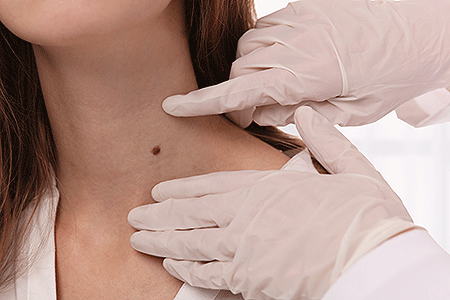 Dermatologist examines mole on patient's neck
