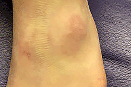 Subcutaneous granuloma annulare on skin