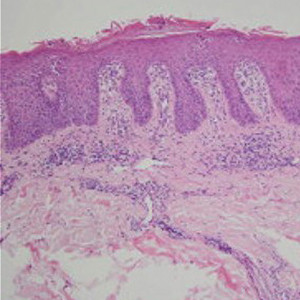 Image for DWII on eosinophils in psoriasis. 