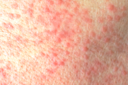 Granuloma annulare causes red, pink, or bluish-purple bumps on the skin