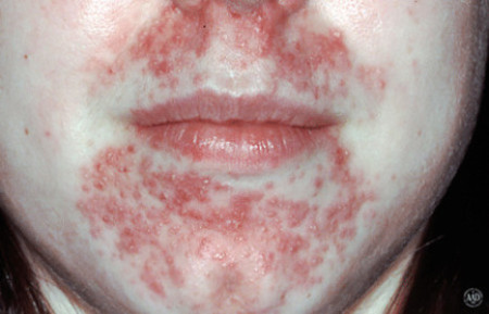 Perioral dermatitis around the mouth