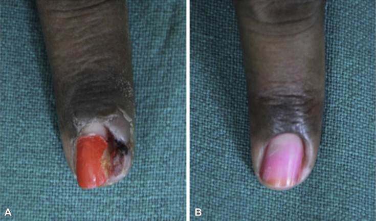 Image for DWII of pyrogenic granuloma treated with salt, from reference 10