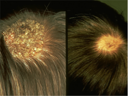 Scalp Conditions Pictures Causes and Treatments