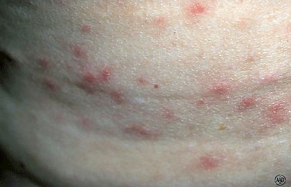 Folliculitis caused by sitting in a hot tub