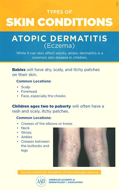 Etiology Of Atopic Dermatitis