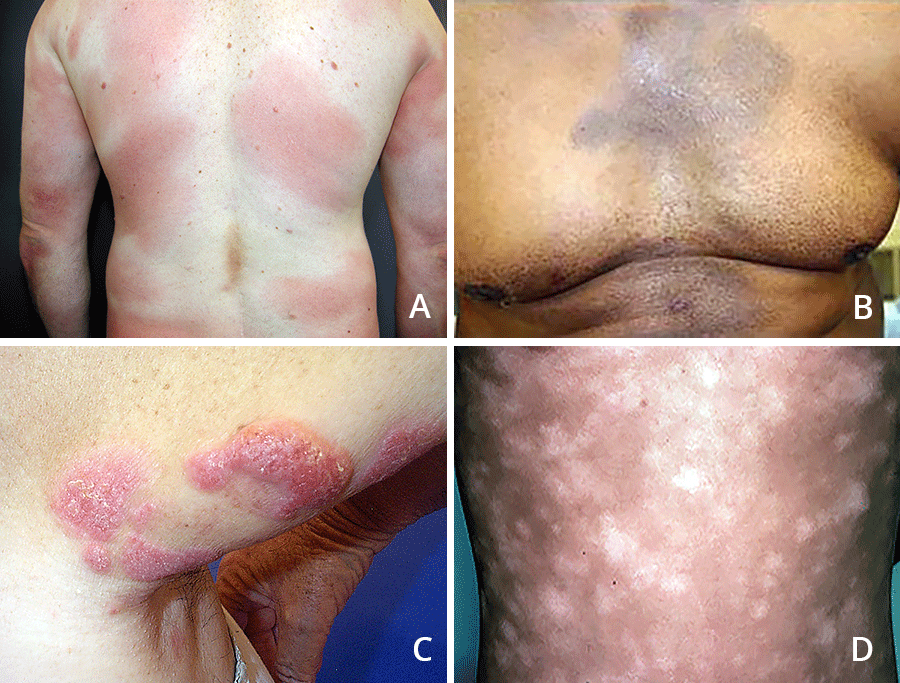 Cutaneous T-cell lymphoma appears on the skin in many ways