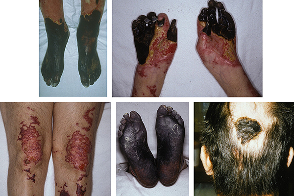 Figure 3. Patient 9 with sequelae to purpura fulminans (Table I). Note gangrene of acral areas, including hands, feet, and occipital scalp. Gangrene necessitated amputation of 4 limbs.(Upper left, Used with permission.1) Source: JAAD. (4, 5)