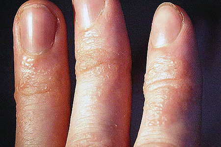 Sweaty skin with dyshidrotic eczema