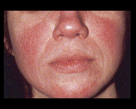 rosacea on face