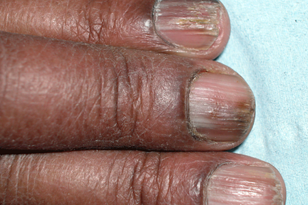 Nail changes, including ridges, caused by lichen planus