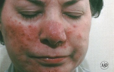 Severe rosacea 