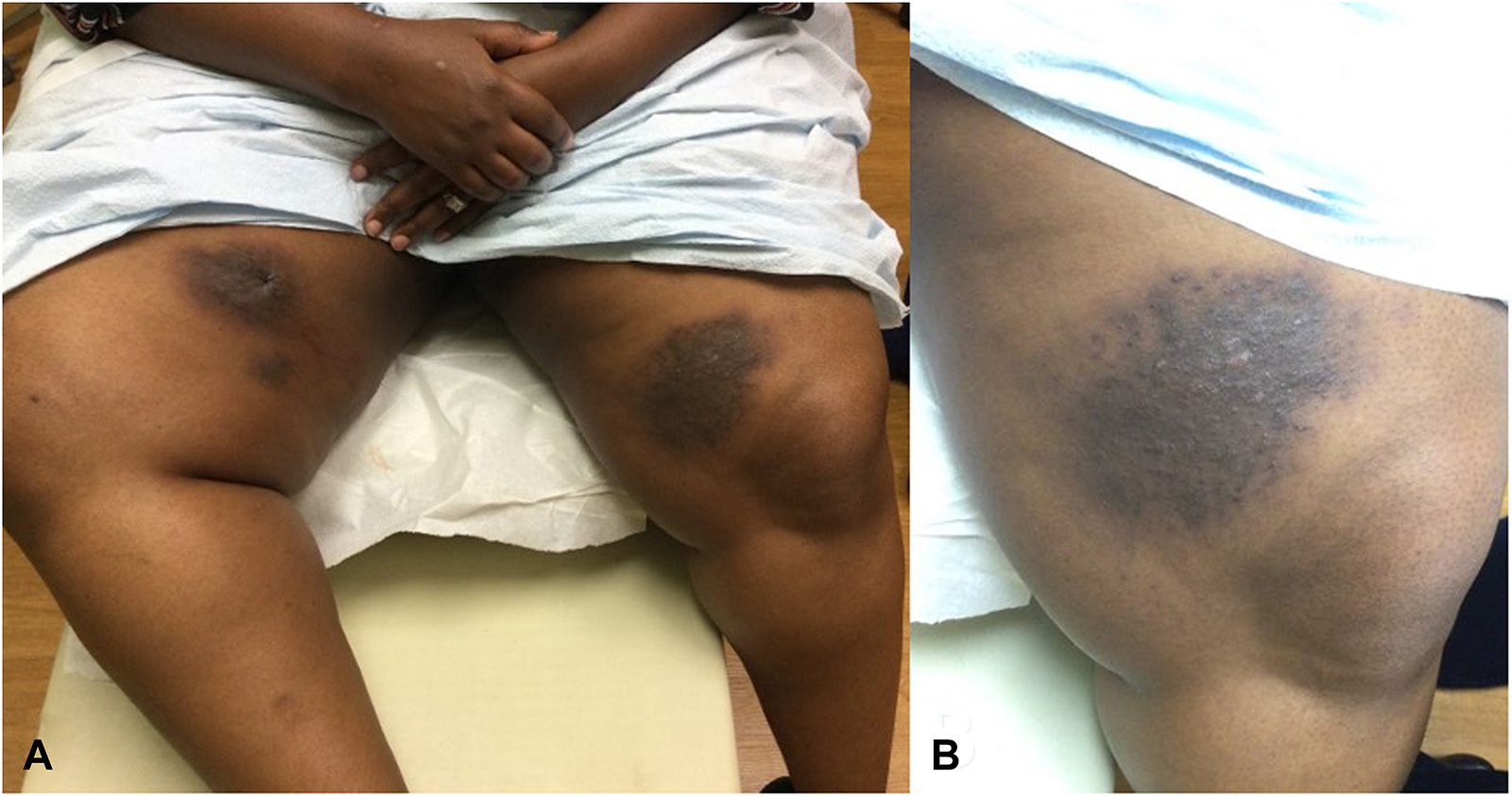 IgG4-related skin disease for DWII | American Academy of Dermatology (AAD)