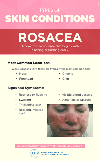 Rosacea infographic