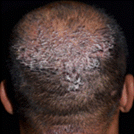 Signs of AKN on the back of the head of a patient with a darker skin tone | American Academy of Dermatology (AAD).