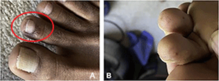 On darker skin tones, COVID toes often have a purplish discoloration (A), some people with COVID toes develop round, brownish spots (B)