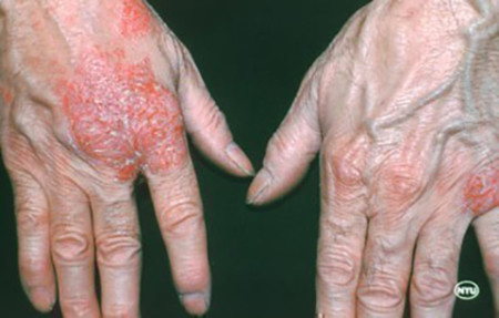 Nummular dermatitis blisters on hands
