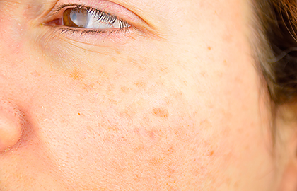 age spots on face