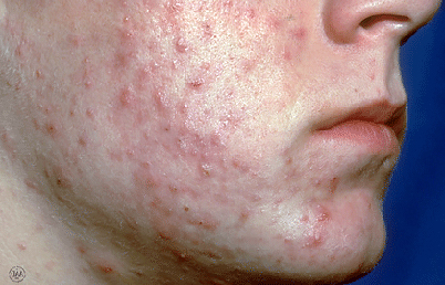 Acne Severe 