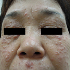 Card image for DWII article on upus miliaris disseminatus faciei, showing an Asian woman whose face shows signs of the condition