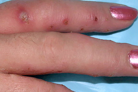 Skin infection caused by scratching itchy fingers.