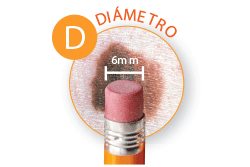 Public>Diseases>Skin-cancer>Types>Melanoma>Symptoms>Diameter (Spanish)