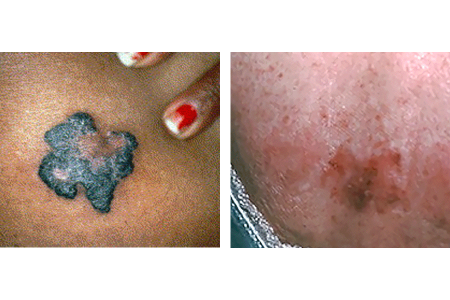 Brown and pink basal cell carcinoma with jagged border on Black woman’s skin (left) and brownish red basal cell carcinoma with jagged border (right)