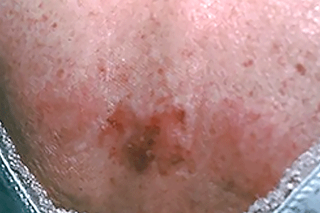 Basal Cell Carcinoma Signs And Symptoms