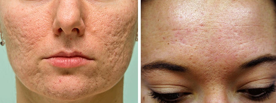 Acne scars on woman’s cheeks, chin, and forehead