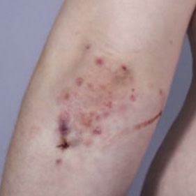 Signs of dermatitis herpetiformis on the arm. 