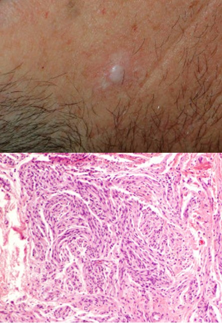 Image for DWII of palisaded encapsulated neuroma and microscopic slide