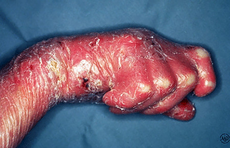 Epidermolysis bullosa scar tissue that has fused a child's fingers together