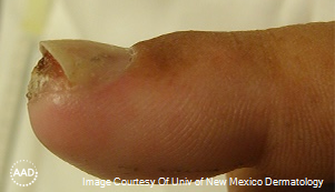 Figure 1. Periungual wart with fissuring, subungual debris, inflammation, and nail plate dystrophy. Source: AAD.